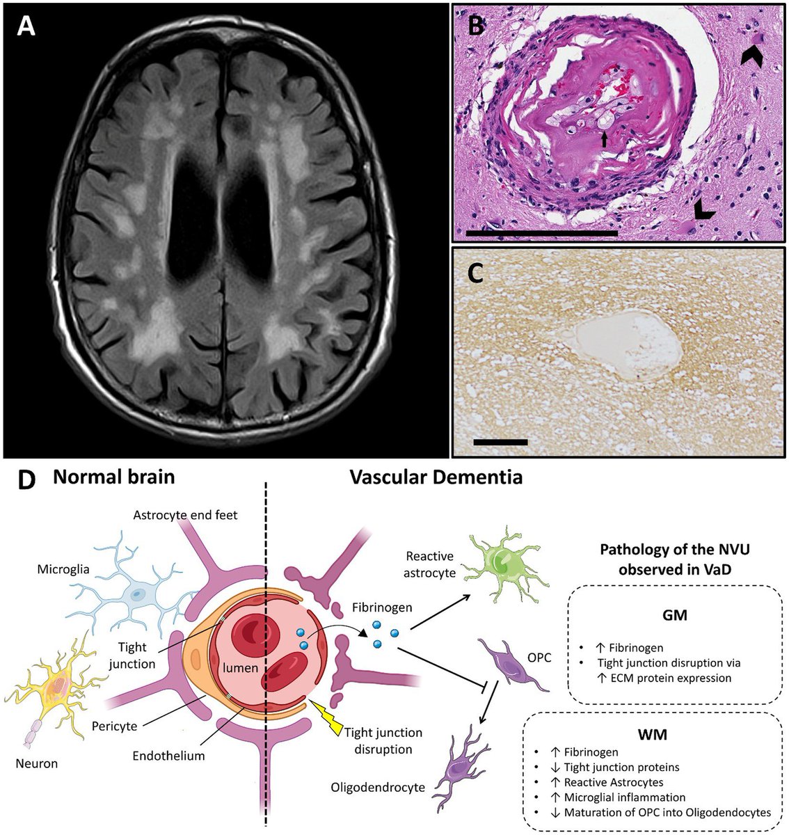 Excellent review article by Gabrielle de Luca <a href="/UniofOxford/">University of Oxford</a> on vascular  contribution to neurological diseases highlighting #fibrin as a common thread in AD, MS and vascular dementia. frontiersin.org/articles/10.33…