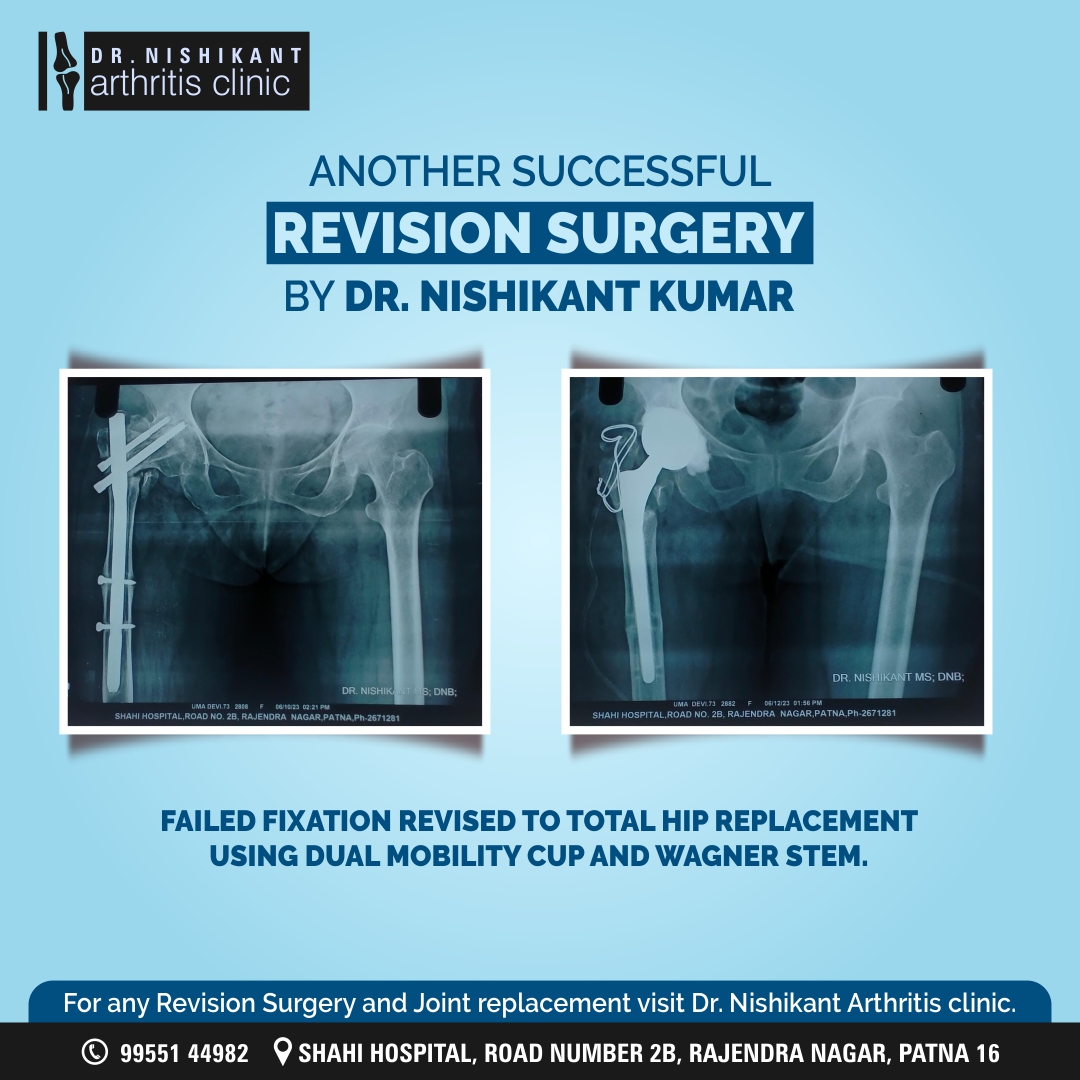 Celebrating Another Triumph in Revision Surgery! 🎉 Dr. Nishikant expertly transforms failed fixation into a Total Hip Replacement with the Dual Mobility Cup and Wagner Stem.
#revisionsurgery #totalhipreplacement #successful
Visit Dr. #Nishikant Arthritis clinic.
Call 9955144982