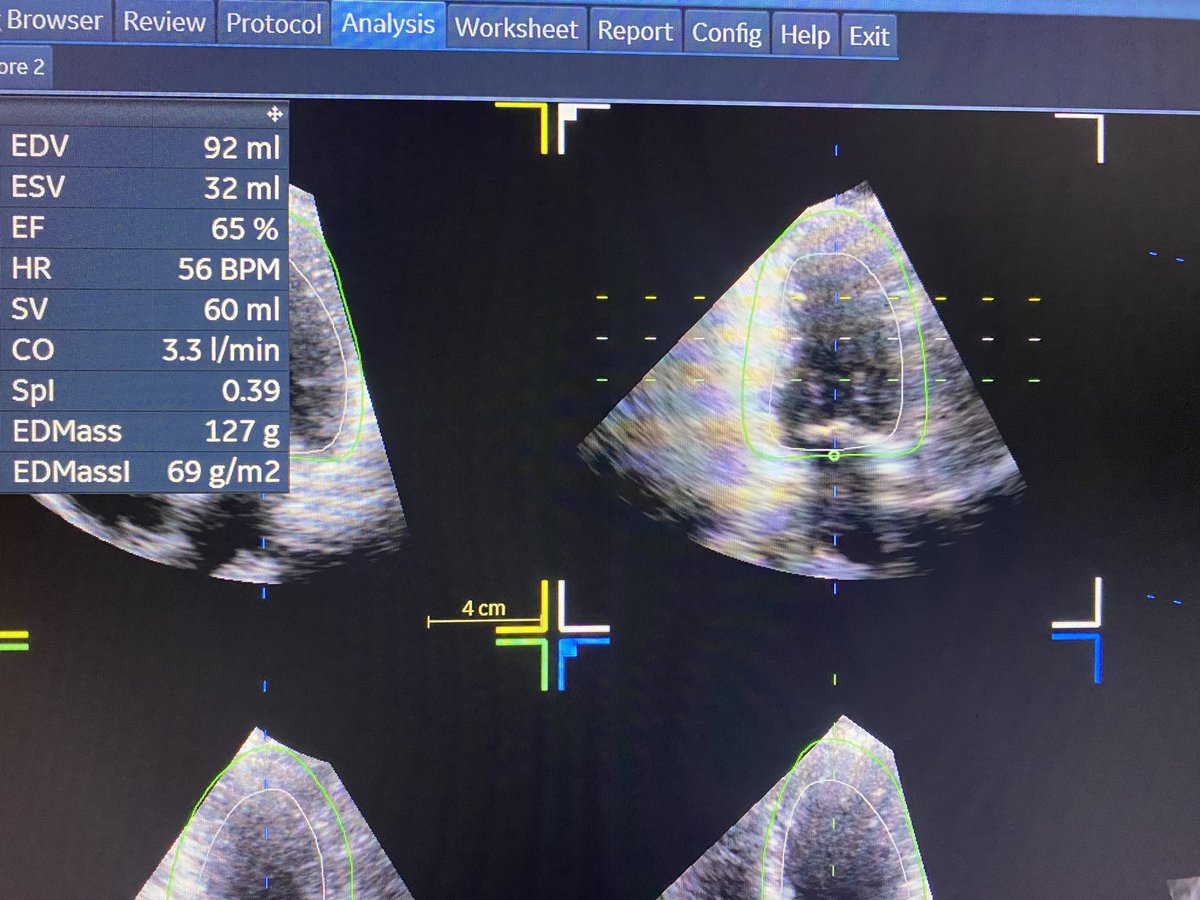 ejchammas's tweet photo. 58 y old female. Dyspnea. AVA continuity 0,9 and planimetry 1,6 cm2. Explanation 🤔 #Cardiotwitter #Echofirst #CardioEd @echocardiac @ASE360 @EACVIPresident @strain_rate https://t.co/9gBvQY2RP5