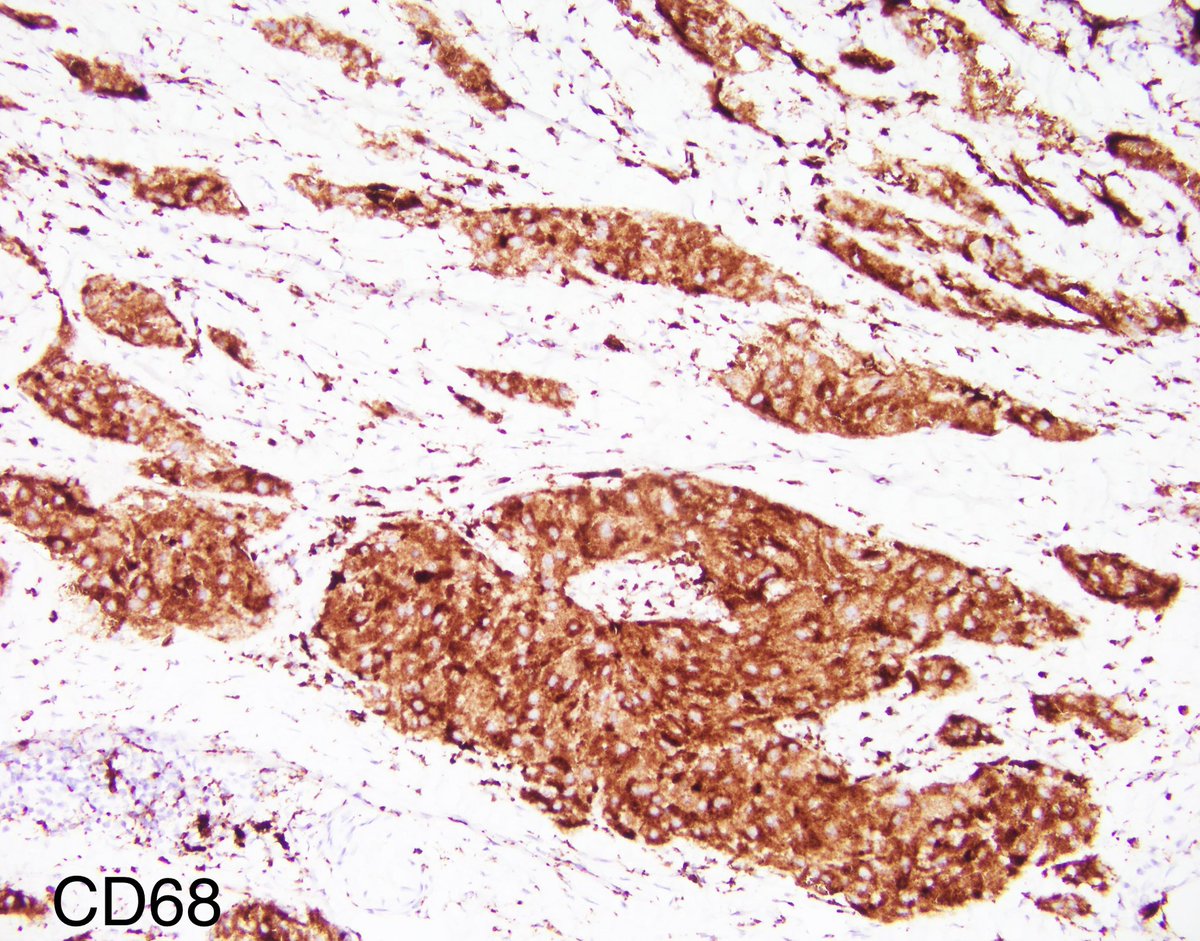 pierocarames25's tweet photo. @PathIsArt @UABPathology Correct!! 
CD68, S100, and SOX10 were all positive. Breast markers were negative in tumor cells. https://t.co/tvseaZ68zF