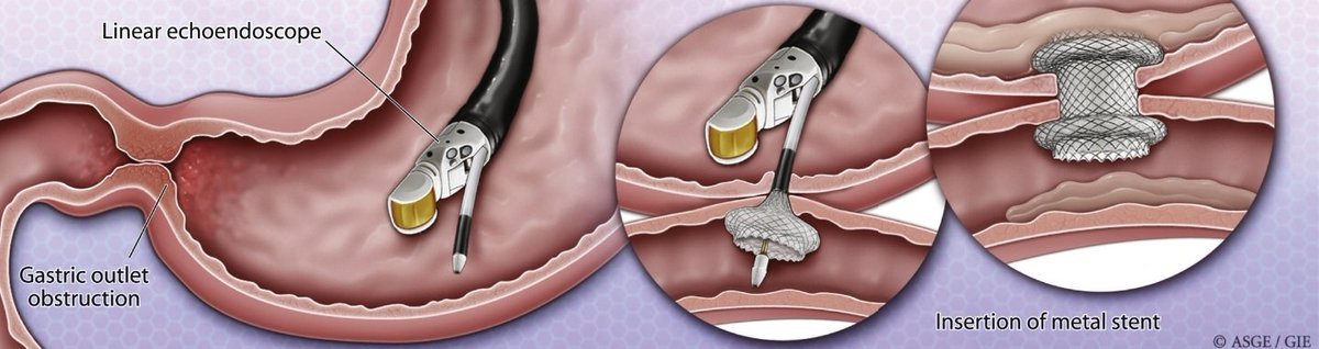 Anjum Gardezi MD (@syedgerdezi) on Twitter photo We did our 1st #EUS_GE <a href="/GwentLiverUnit/">Gwent Liver Unit</a> in Wales🏴
Extremely grateful to <a href="/CaptCholangio/">Marek Czajkowski</a> for his untiring efforts in developing therapeutic #EUS program & <a href="/helpatologist/">Nadeem Tehami</a>
for going out of the way in helping us selflessly & bringing these niche skills in 🏴
<a href="/Srisha_Hebbar/">Srisha Hebbar</a> <a href="/docdhir/">vinay dhir</a> We did our 1st #EUS_GE <a href="/GwentLiverUnit/">Gwent Liver Unit</a> in Wales🏴
Extremely grateful to <a href="/CaptCholangio/">Marek Czajkowski</a> for his untiring efforts in developing therapeutic #EUS program & <a href="/helpatologist/">Nadeem Tehami</a>
for going out of the way in helping us selflessly & bringing these niche skills in 🏴
<a href="/Srisha_Hebbar/">Srisha Hebbar</a> <a href="/docdhir/">vinay dhir</a>