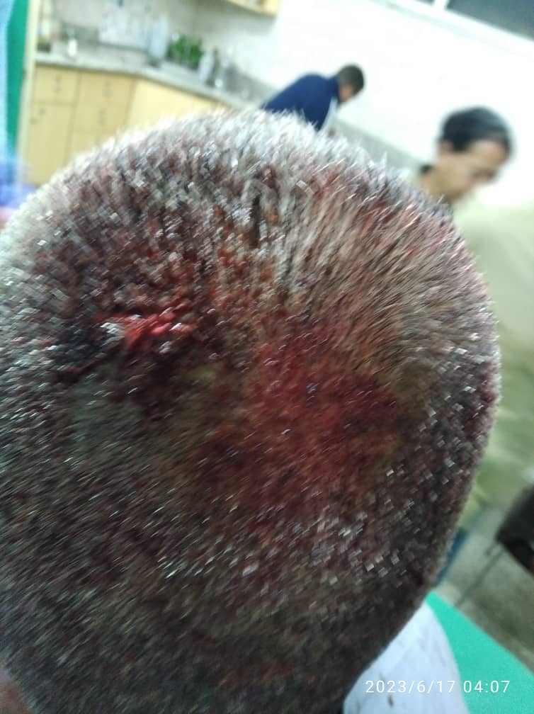 vamosfmo's tweet photo. #NOTICIA El día de ayer Óscar Rodríguez, trabajador de Protección de Planta de Alcasa fue golpeado por bandoleros, conocidos como Garimpeiros,  dentro de la planta que ingresan a extraer chatarras. El Jefe de Óscar lo mando al recorrido solo y a pies, algo que no está permitido https://t.co/ccmfHCwo74