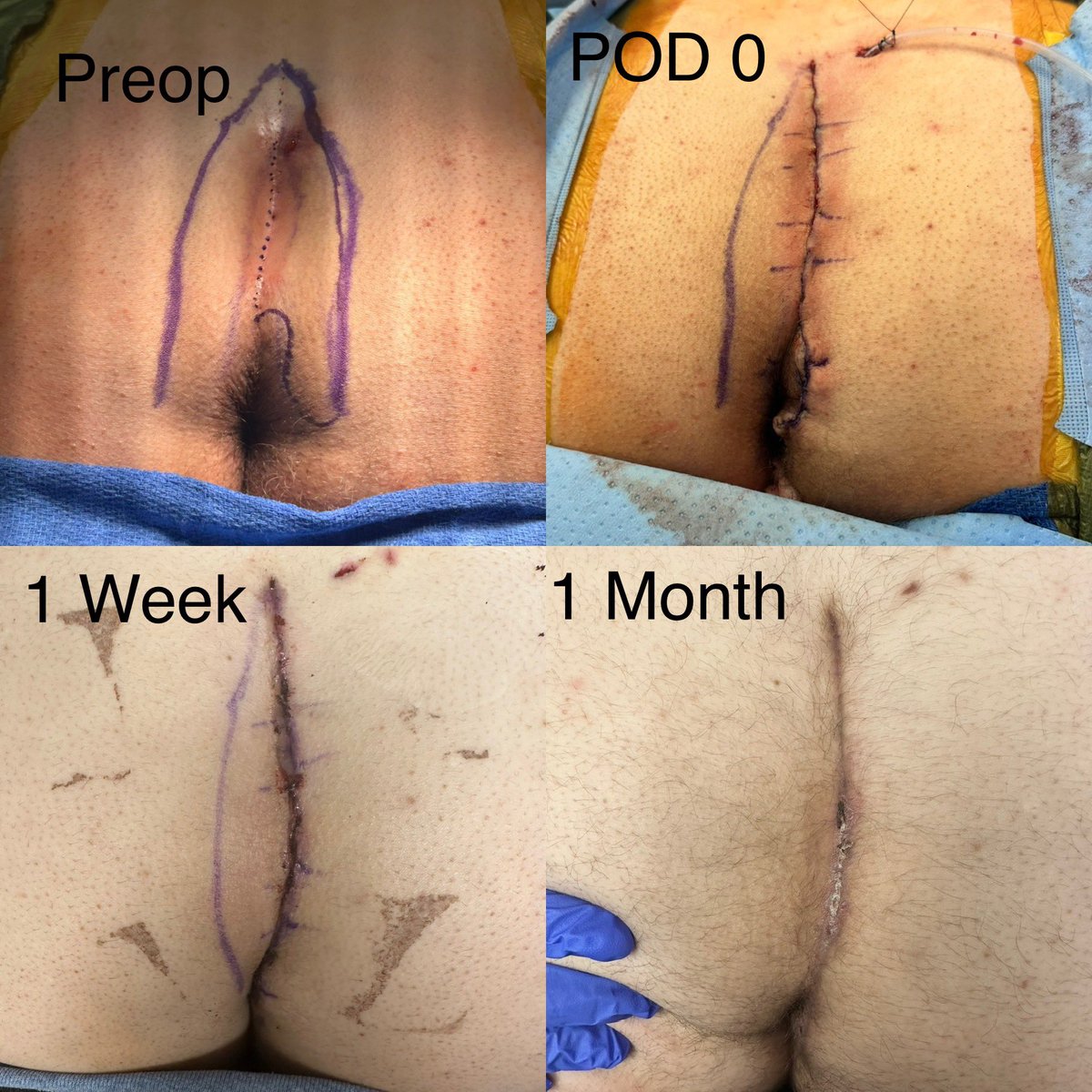 <a href="/JeffSternberg1/">Pilonidal USA</a> this is becoming my go to for Pilonidal disease. Patient did amazingly well and very happy. Thanks!! Head over to <a href="/surgeonapp1/">SurgeOn</a> to watch Dr. Sternberg discuss The Cleft Procedure for Pilonidal disease. share.surgeonapp.com/public/share/3…