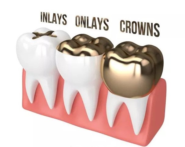 thetooth_dr's tweet photo. An inlay is a single solid piece to fill the cavity, An onlay is pre-molded to fit the inside &amp; outside portions of the tooth, and Dental crowns strengthen existing teeth by providing a strong outer covering.

#flossdental  #maltepedental #inlay #onlay #crown #trinidadandtobago https://t.co/EOOIfeVa0g