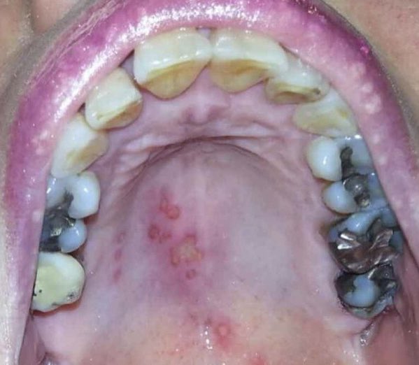 drgallagher_'s tweet photo. Oral Herpes Simplex Virus key features:

• Painful, grouped vesicles on an erythematous base that progress to form shallow ulcers in the oral cavity.

#pathology #oralpathology #dentistry #herpes #oralsurgery #oralhealth #herpessimplexvirus #hsv https://t.co/qpfecHCamJ