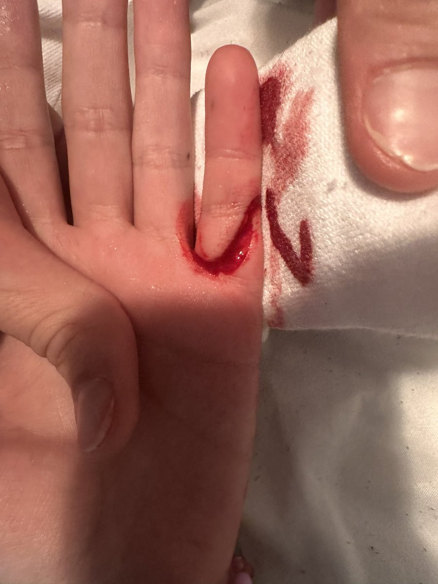 MY FRIEND RIPPED A RAZOR OUT OF MY HAND DID MORW HARM THAN I WOULD’VE