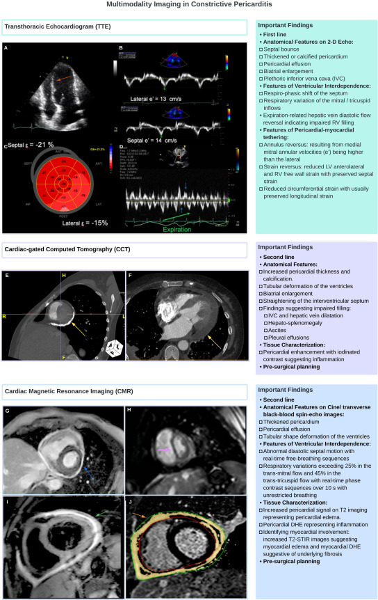 SeguraCardio's tweet photo. 📌A Contemporary Approach to the Diagnosis & Management of #Constrictive #Pericarditis
#CardioTwitter #CardioEd #Review https://t.co/uC5Flc71tj