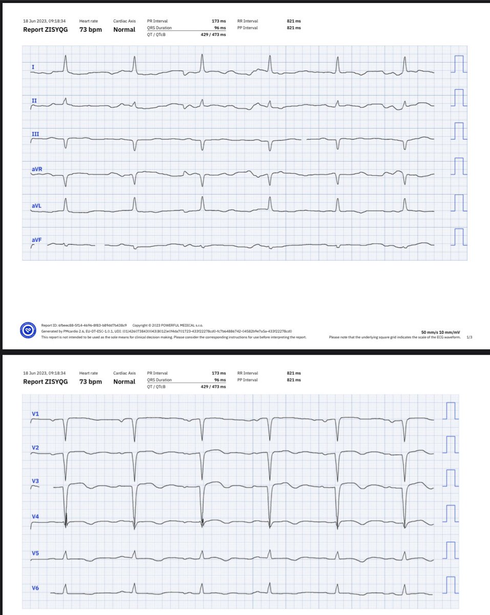 QoH says NSTEMI but this is OMI to my eyes - am I wrong? 
@RobertHermanMD @smithECGBlog @ecgrhythms