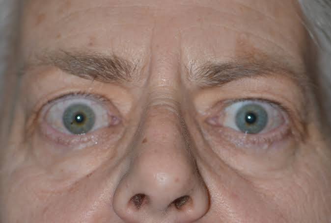 Drgomathi_tn's tweet photo. Spot Diagnosis.👀
What abnormalities do you see in this patient? What's the likely diagnosis?
#MedTwitter #medicine #MedEd #surgery #Medical #Health #Clinical https://t.co/tqPJ8AMgz2