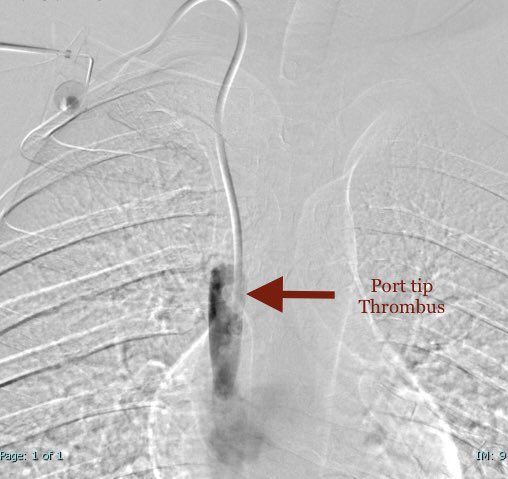 6/
Port tip thrombus/fibrin sheath 
.
Occasionally presented with no backflow, although forward flow may be present 
.
Tx: May still be used for drug delivery, antocoagulation, Thrombolysis, fibrin sheath snaring, portcath exchange #MedEd #MedTwitter #hematology