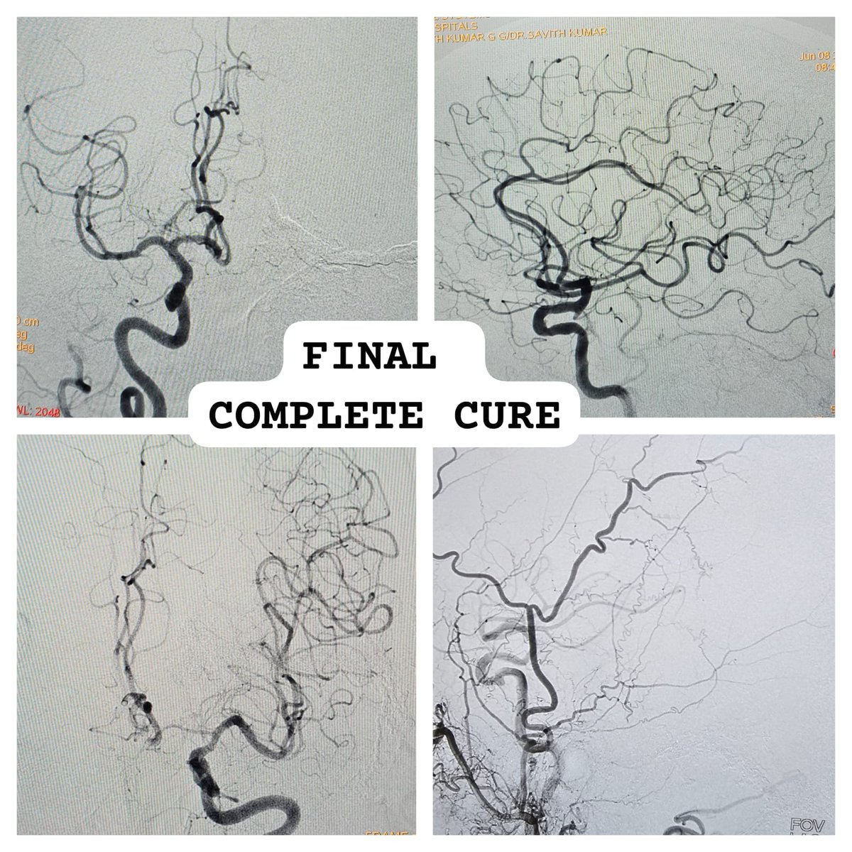 Another important  treatable  cause of dementia  & parkinsonism is Cerebral  dural arteriovenous fistula (DAVF)! An enigmatic  disease with varied clinical presentation! RX@Apollo #Neuroradiology #neurology #DAVF #Dementia #stroke #neuroimaging #Neurointervention #Embolization