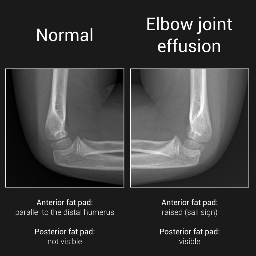Radiopaedia.org
Excellent slides: Elbow joint effusion vs normal elbow #radres #MedTwitter 

Case courtesy of Leonardo Lustosa, Radiopaedia.org, rID: 166237