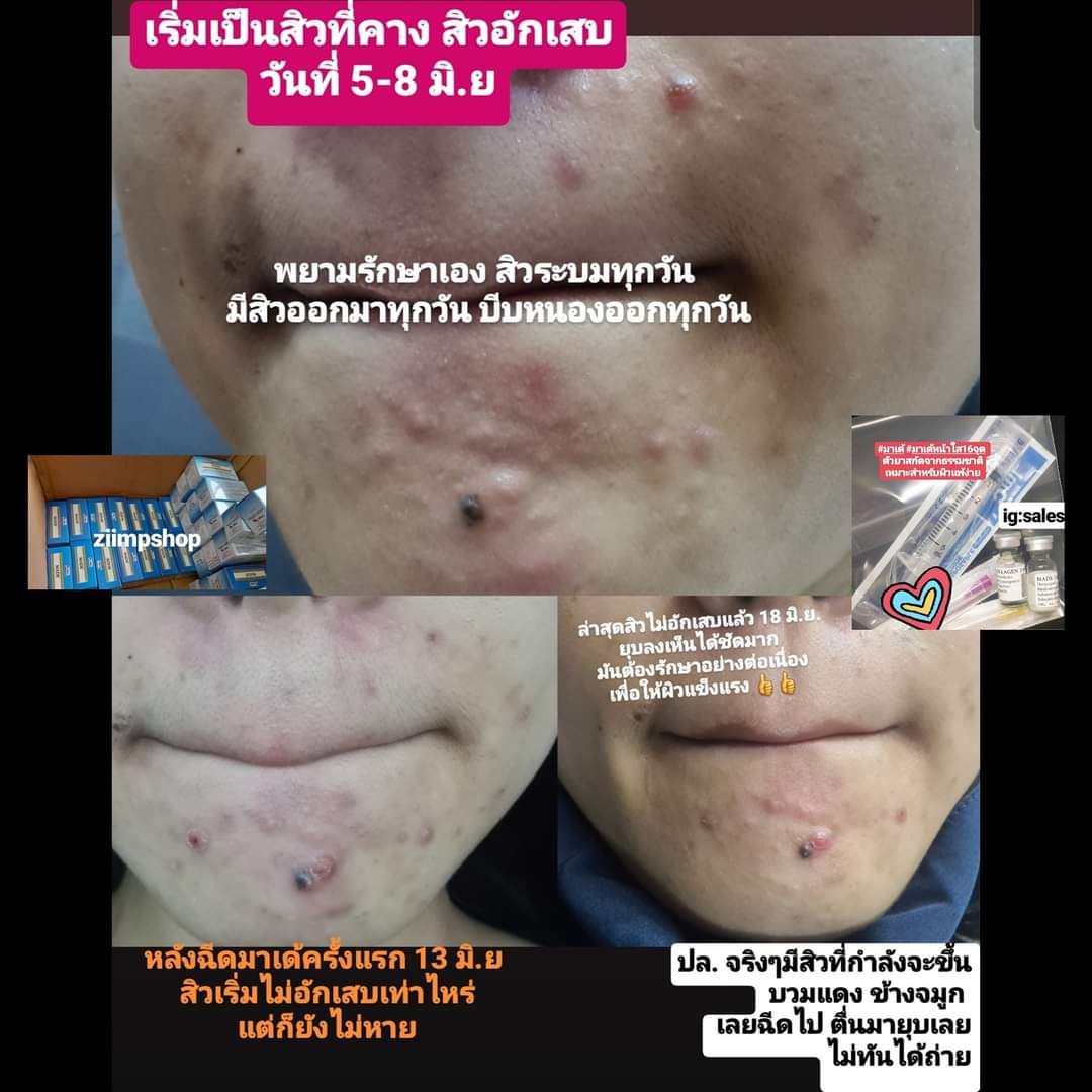 MESooooo250's tweet photo. #มาเด้หน้าใส #มาเด้หน้าใส16จุด #มาเด้คอนลาเจน #Madecollagen 
ยกกล่องสุดคุ้ม แถมชุดเข็ม10 ชุด 2,×××
แบ่งขาย1 คู่ = 300฿ พร้อมชุดเข็ม 😍 https://t.co/0eCUnpxQyO