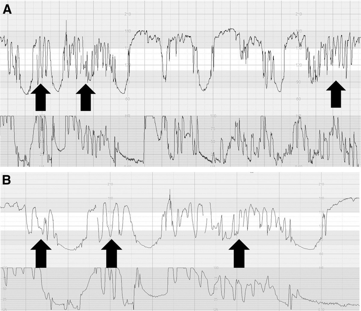 AJOG_thegray's tweet photo. AJOG Expert Review:  Pathophysiological interpretation of fetal heart rate tracings in clinical practice - ZigZag Pattern
Note the transient, abrupt, up-down fluctuation across the baseline, called the “zigzag” pattern because of autonomic instability.  https://t.co/1nVBhQ2zh1 https://t.co/jb33jIULnB