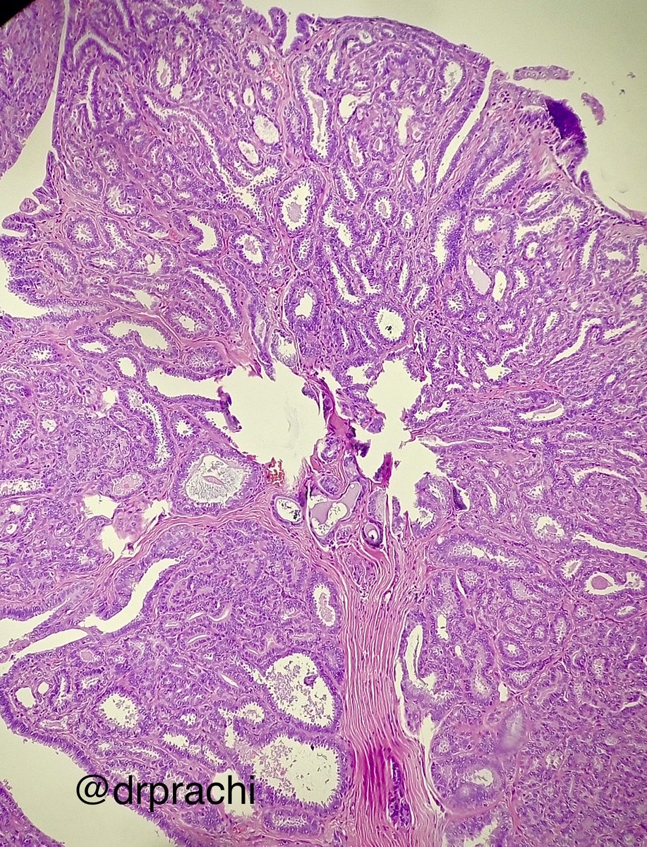 Prachi (@prachipath123) on Twitter photo Mammary like lesion of vulva- Papillary Hidradenoma- classical histological features- @specialstainsinhostopathology <a href="/archibhat3/">Archana bhat</a> <a href="/PathTweetAward/">Educational Pathology Tweet Award</a> #crittersontwitters <a href="/mathuraiims/">Sandeep Mathur</a> <a href="/FlyFan7/">fanbotao</a> <a href="/DrGeeONE/">Olaleke Folaranmi</a> <a href="/pathologistmag/">The Pathologist</a> <a href="/TurkJPath/">Turkish J Pathology</a> Mammary like lesion of vulva- Papillary Hidradenoma- classical histological features- @specialstainsinhostopathology <a href="/archibhat3/">Archana bhat</a> <a href="/PathTweetAward/">Educational Pathology Tweet Award</a> #crittersontwitters <a href="/mathuraiims/">Sandeep Mathur</a> <a href="/FlyFan7/">fanbotao</a> <a href="/DrGeeONE/">Olaleke Folaranmi</a> <a href="/pathologistmag/">The Pathologist</a> <a href="/TurkJPath/">Turkish J Pathology</a>