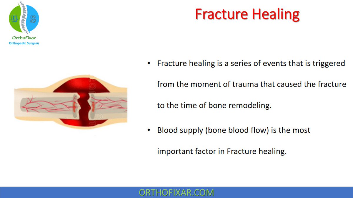 LebariClem58118's tweet image. #BASIC_SCIENCE #orthofixar #orthopaedic
Fracture Healing
Fracture healing is a series of events that is triggered from the moment of trauma that caused the fracture to the time of bone remodeling.