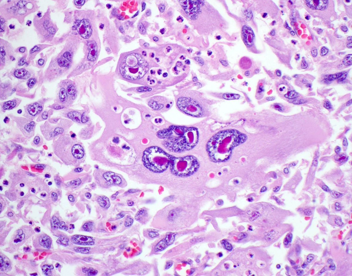 Now THAT's Cherry-Red Nucleoli! (but it isn't melanoma). Answer & more pics here: kikoxp.com/posts/10213. Video on how I work up pleomorphic spindle cell tumors (IHC etc): kikoxp.com/posts/9839. #BSTpath #pathologists #pathology #pathTwitter #dermpath #dermatology #dermtwitter
