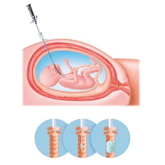 ISUOG's tweet photo. #UOGJournal: Janssen et al. demonstrate that an amniotic plug used at time of FETO for congenital diaphragmatic hernia is cost-effective, even with a small reduction in risk of PPROM/preterm delivery: https://t.co/sUWHvuNyZr 
#ISUOG #LoveUltrasound @WileyHealth https://t.co/A4U0xVQkfk