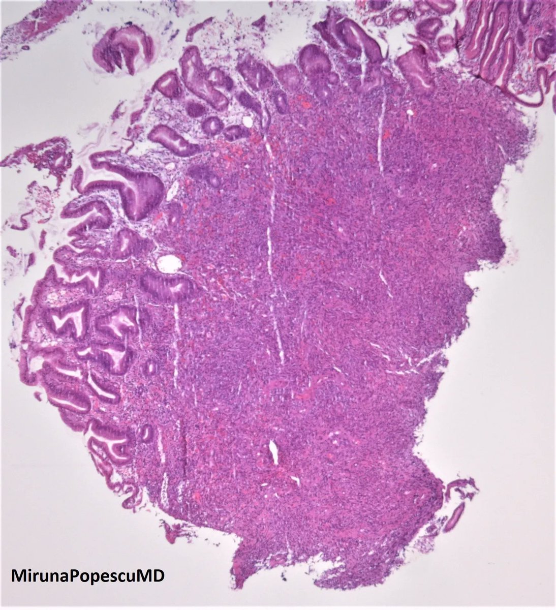 Gastric nodule biopsy. Diagnosis? 
More pics & Answer: kikoxp.com/posts/19684 
More posts in Dr. Popescu @MirunaPopescu13 : kikoxp.com/posts/18167 
#pathology #pathTwitter #medTwitter #GIpath