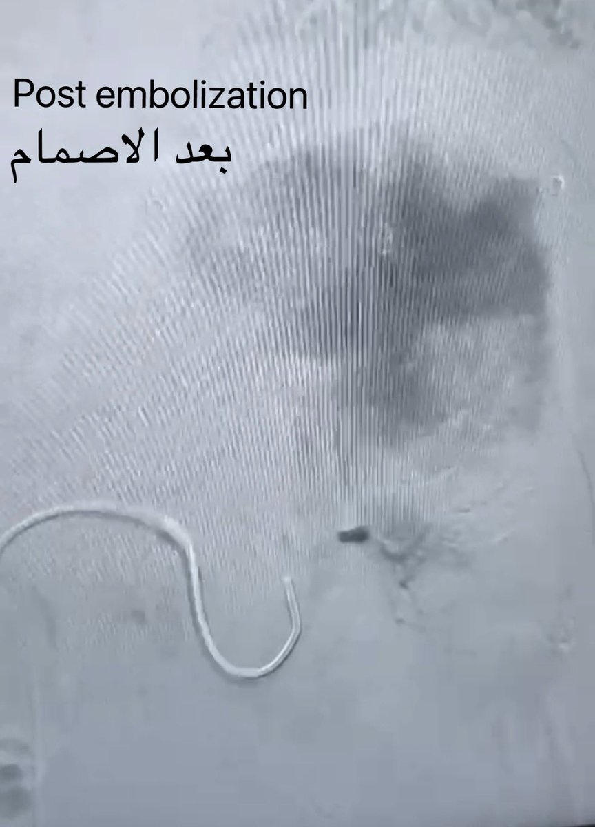 pt with hyperspleenism plt count 3 ,Had partial spleenic artery embolization 4 weeks back,today his count 399
مريض يعاني من فرط في وظائف الطحال نتج عنه تكسر الصفائح الدموية لعدد ٣ فقط بإستخدام الاشعة التداخلية تم اصمام شريان الطحال جزئيا الان وبعد ٤ اسابيع ارتفعت ل ٣٩٩ <a href="/sirs_ksa/">Saudi Interventional Radiology Society</a>