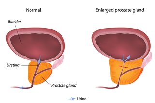 PROSTATE-THREAD