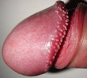 GYerathel's tweet photo. Pearly penile papules

Also known as hirsutoid papillomas, are small, skin-colored bumps that form around the head of the penis. While they may seem alarming, they are harmless and tend to fade in appearance as you age.

A papule is a raised, https://t.co/YMyDsI2LPw