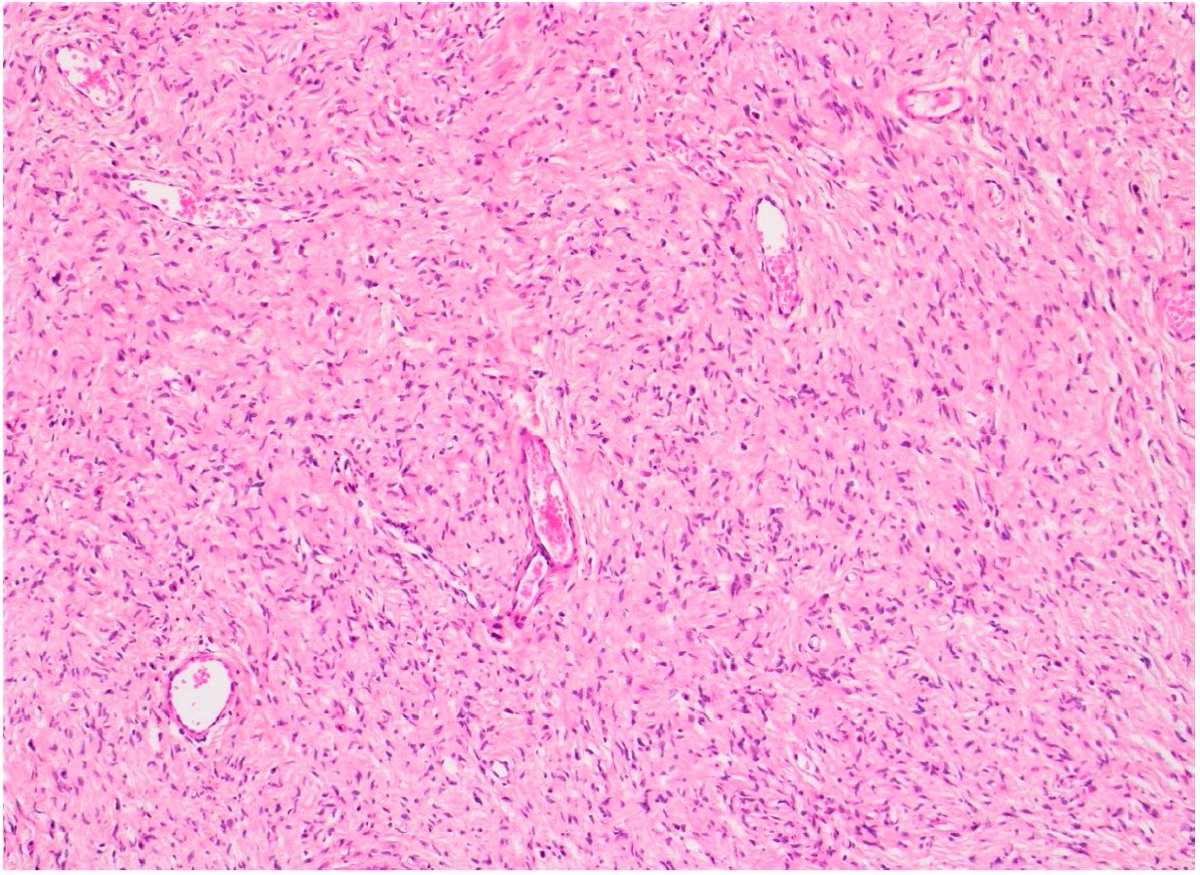 #mdpidermatopathology 
#highlycitedpaper  Call for Reading:
Type I Neurofibromatosis: Case Report and Review of the Literature Focused on Oral and Cutaneous Lesions #dermtwitter

by Samanta Buchholzer, Raùl Verdeja and Tommaso Lombardi
Free Access 👇
mdpi.com/2296-3529/8/1/3