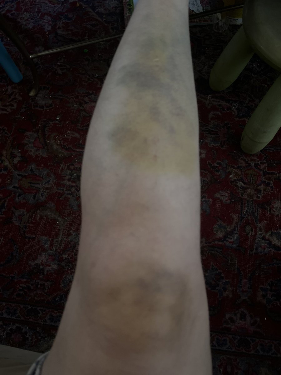 #ItsNeverTooLate to fall down a huge flight of concrete stairs and destroy your legs, knee, and hand for summer. I’m so mad. 😭 please send home cures for giant bruises.