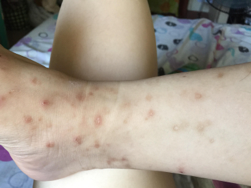 MnSM_77's tweet photo. Have you been bitten by a mosquito recently? Are you annoyed? I certainly do. My arm looks like cylindrical calzone filled with mini pepperonis, when you look at it from the inside out! I was so close to invest in a mosquito trap but it seems they're satiated for now. #39canimals https://t.co/tJqJb6HlNe