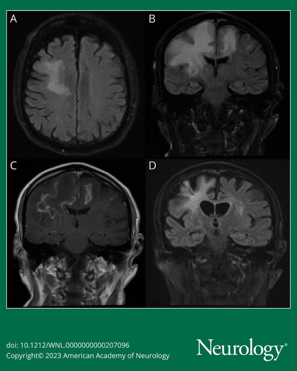 Clinical Reasoning: Progressive Hemiparesis and White Matter Abnormalities in an HIV-Negative Patient. bit.ly/43ELMt7

#NeurologyRF #NeuroTwitter