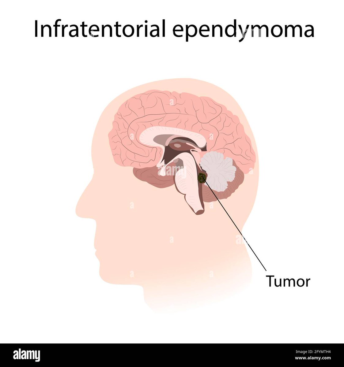 An infratentorial ependymoma is a type of brain tumor that occurs in the lower part of the brain, near the spinal cord. It is a type of ependymoma, which is a tumor that arises from cells that line the fluid-filled spaces in the brain.
