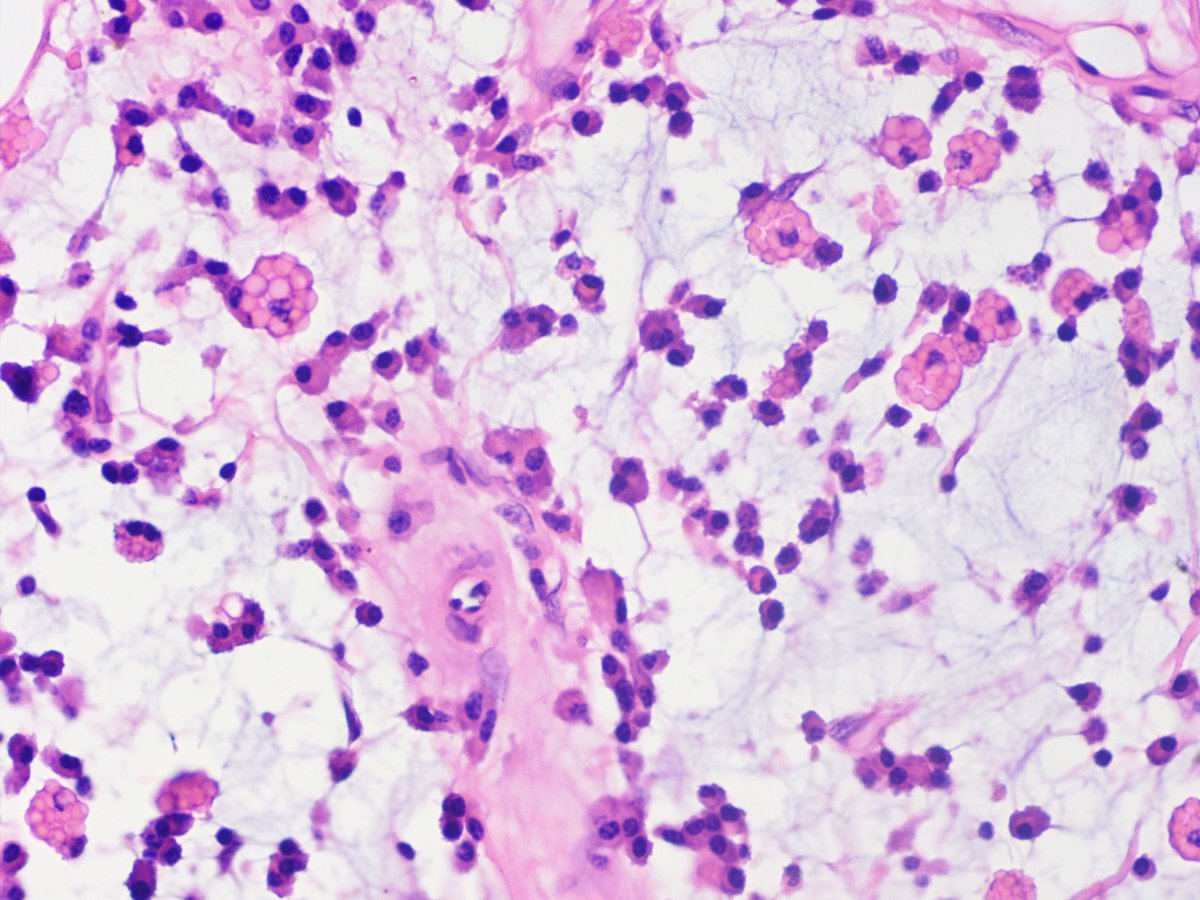 65/M, dilated pelvicalcyceal system with caculi, renal sinus picture in nephrectomy specimen #pathtwitter #renalpath #histopath #pathology #pathresidents #pathologists