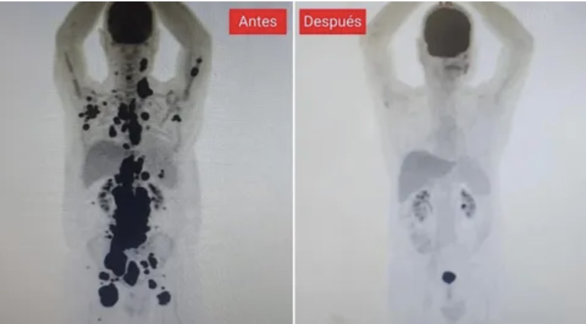 LRsecreta's tweet photo. El antes y después de un paciente con linfoma: cómo la terapia CAR-T curó en un mes su cáncer con metástasis

El paciente, de 61 años, tenía una leucemia y la quimioterapia y el trasplante de médula habían fracasado

👉 …¡hay que invertir en investigación! ⛔️ https://t.co/oGpz8vFuFM
