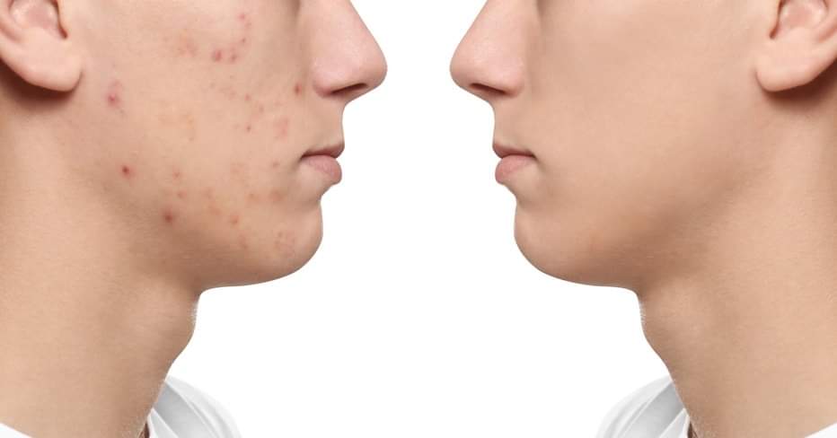 ProtektOnline's tweet image. Want to keep your skin looking clear and healthy? Incorporate topical probiotics into your skincare routine! These beneficial bacteria can help balance the skin&apos;s natural microbiome, preventing acne and promoting a clearer complexion. #clearcomplexion #probioticskincare