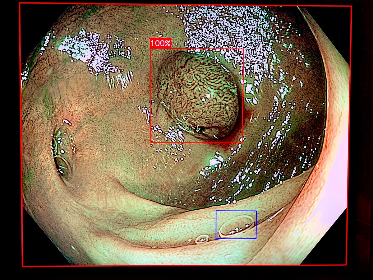 PolyDeep:
<a href="/pontegastro/">Digestivo Pontevedra Hospital Universitario</a> se une al Grupo de Investigación en Oncología Digestiva del CHUO, a la Escuela Superior de Ingeniería Informática de Ourense y a la UniVigo en un proyecto de aplicación de la IA 🤖 a la detección y clasificación de pólipos colorrectales.