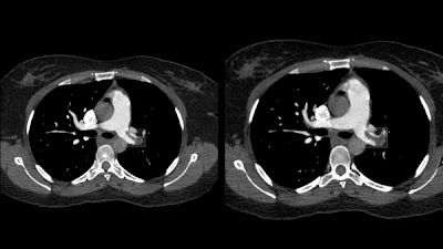 Radiology_AI's tweet photo. Augmented @RSNA Pulmonary Embolism CT dataset: 445 studies with 30,243 bounding boxes applied to 14,865 images https://t.co/DeNPAckdB2 @UnityHealthTO @UofTMedIm #PE #RSPECT #AI https://t.co/ClfNfg0HFc