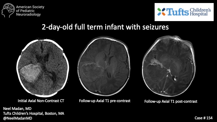 Case of the week: 2-day-old full term infant with seizures  Thank you

@neelmadanmd
from Tufts Children's Hospital. #PediNeuroRad #MedEd #FOAMrad #PedsRad #RadRes #NeuroRad #FOAMmed