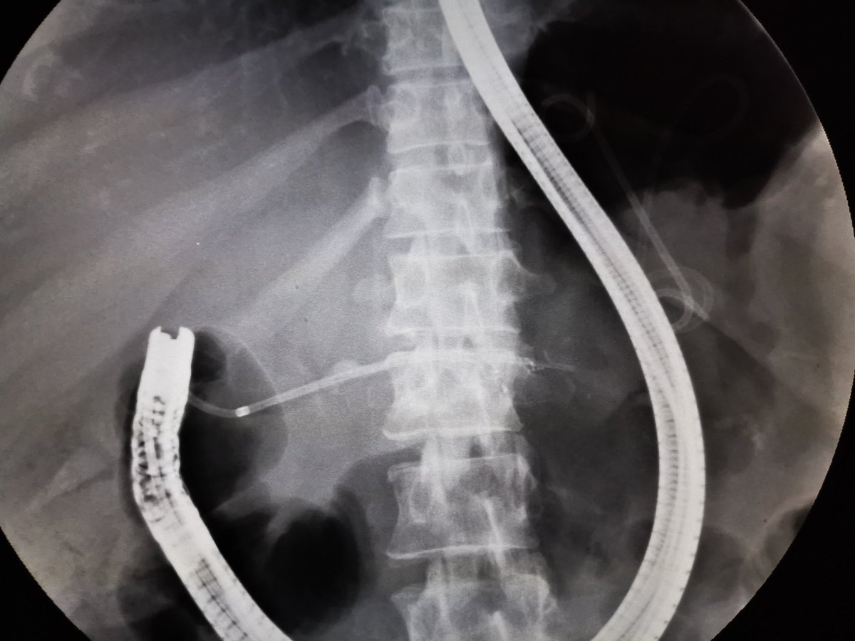 GewGastro's tweet photo. Recurrent pancreatitis with Pancreatic Divisum with Disrupted duct syndrome. Cannulated through minor ampulla, passed wore through the disrupted segment to tail, done sphincterotomy and stented through it. https://t.co/ZCak7IXvUT