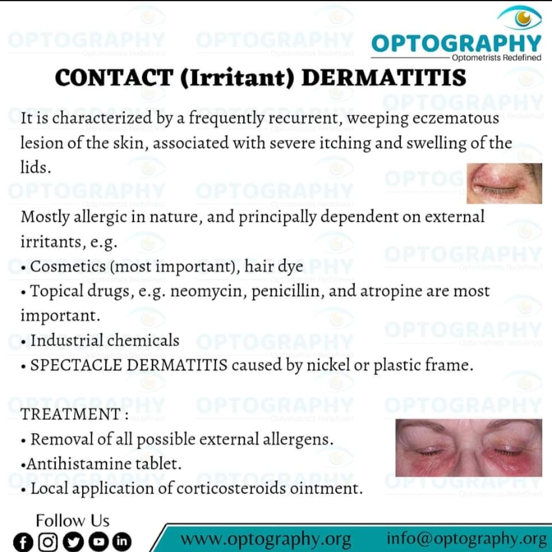 Contact dermatitis causes the skin to become itchy, blistered, dry and cracked. Lighter skin can become red, and darker skin can become dark brown, purple or grey. This reaction usually occurs within a few hours or days of exposure to an irritant or allergen.

#eyecare