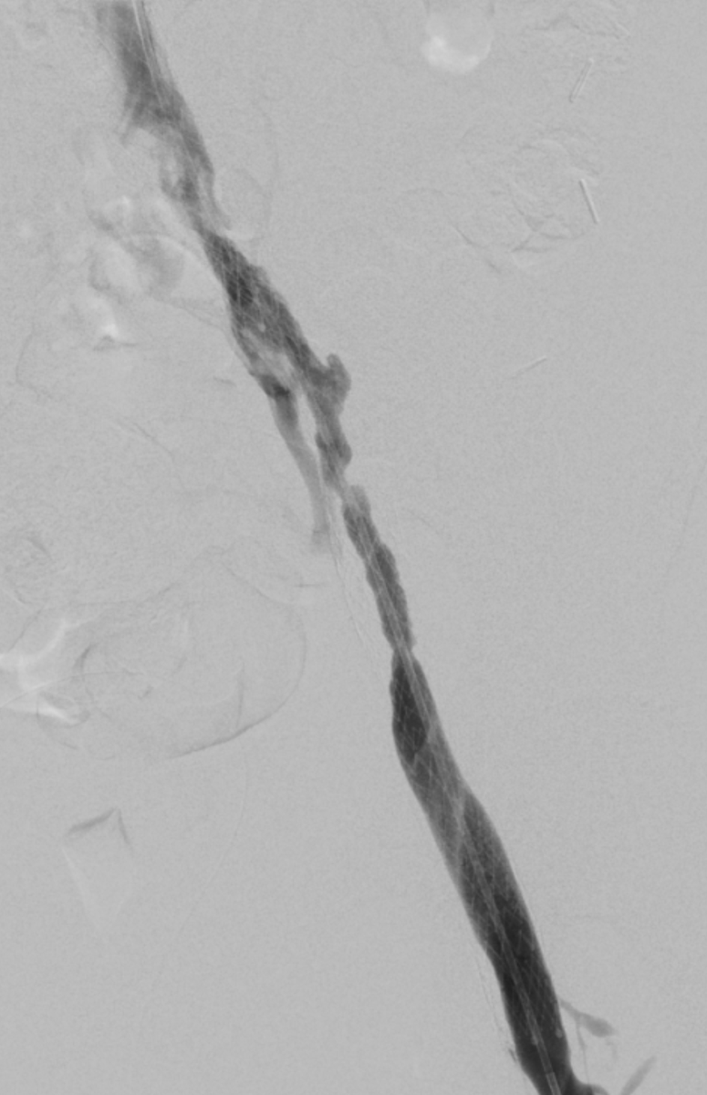 RCobbMD_IR's tweet photo. Pt w/GYN cancer related iliac vein occlusion s/p recan/stent few months prior w/near occlusive in-stent thrombus return of severe symptoms and wheelchair bound https://t.co/bseAdqqYAh