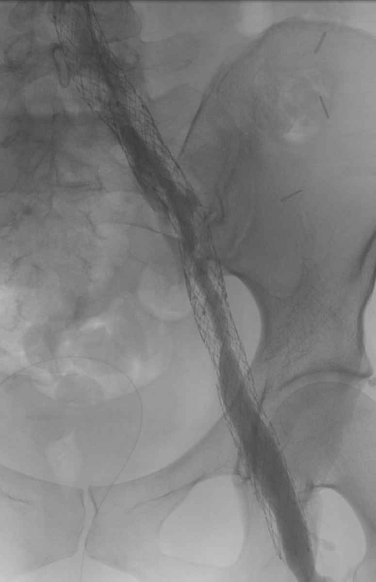 RCobbMD_IR's tweet photo. Pt w/GYN cancer related iliac vein occlusion s/p recan/stent few months prior w/near occlusive in-stent thrombus return of severe symptoms and wheelchair bound https://t.co/bseAdqqYAh