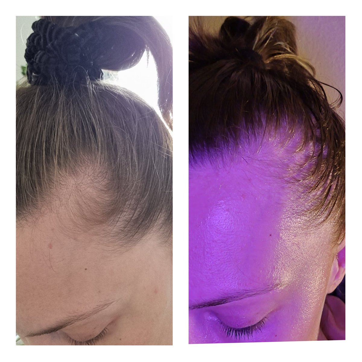 LoaScientist's tweet photo. I can vouch for this. I used affirmations to grow hair in a bald spot, when I first started I didn't believe it but knew my sub would take it as gospel. Peep the photos 👀 now I have a mane of hair 🦁 the spot is entirely covered now, the pics show the progress. https://t.co/2QJZf9EudJ