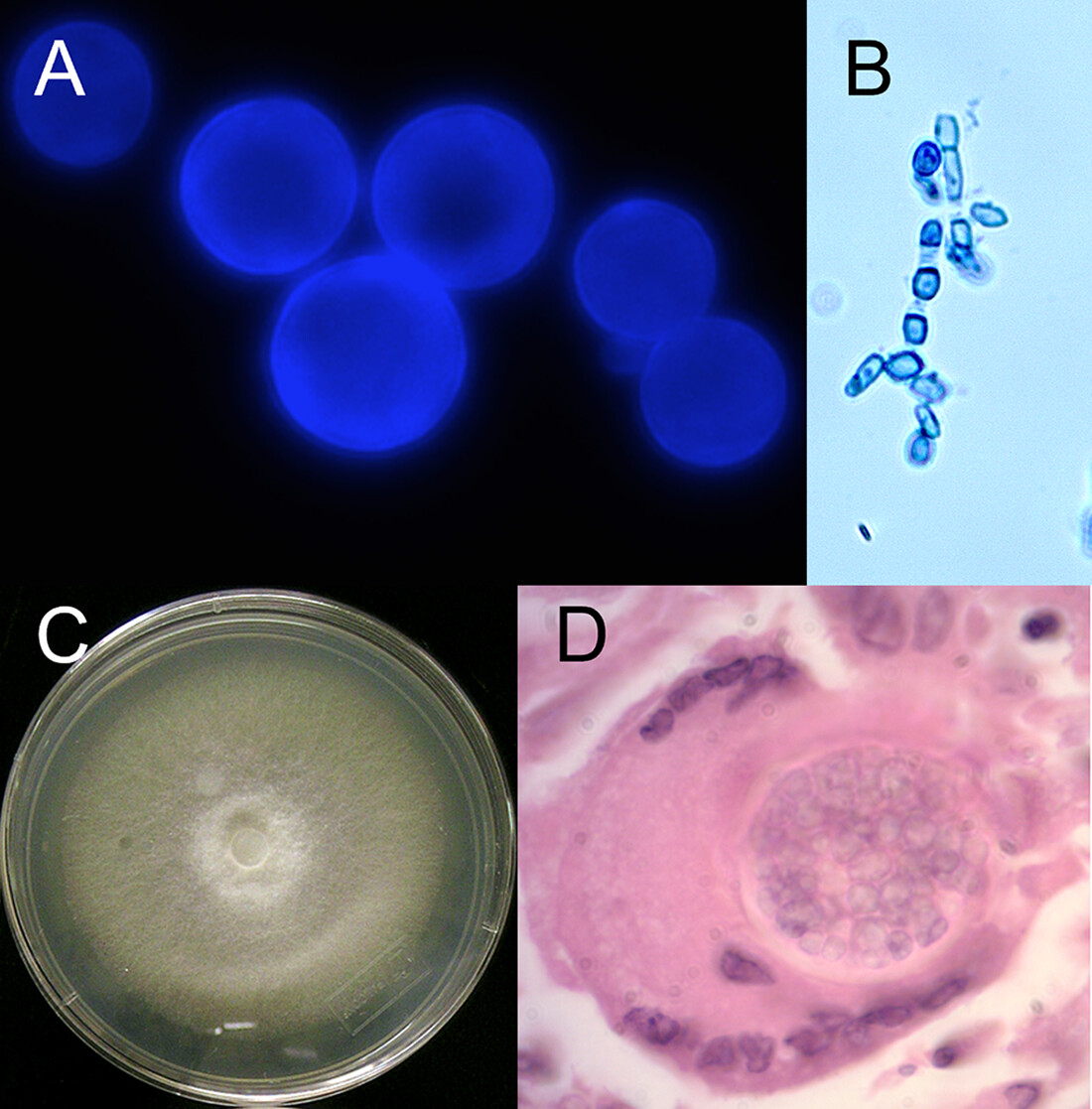 Review of Clinical and Laboratory Diagnostics for Coccidioidomycosis tinyurl.com/bdz6vbax A. Calcofluor white B. Mycelial arthroconidia, lactophenol cotton blue C. Coccidioides mold D. A spherule engulfed in a multinucleated giant cell, H and E @ASMicrobiology