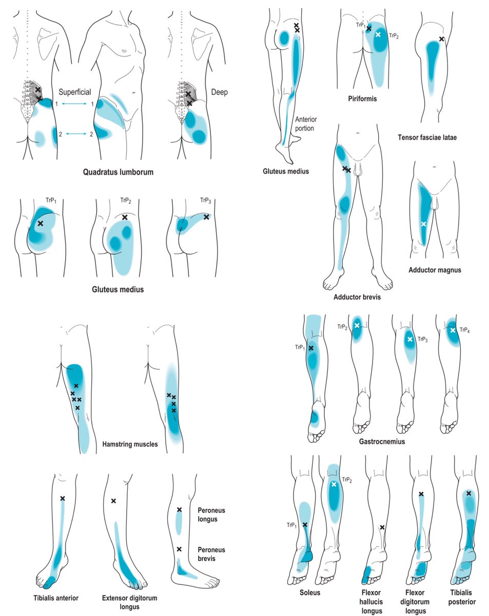 TurkiPT1's tweet photo. Muscle trigger points pain 🛑👇🏼✨
—————————————— https://t.co/Nlb5COBlZz