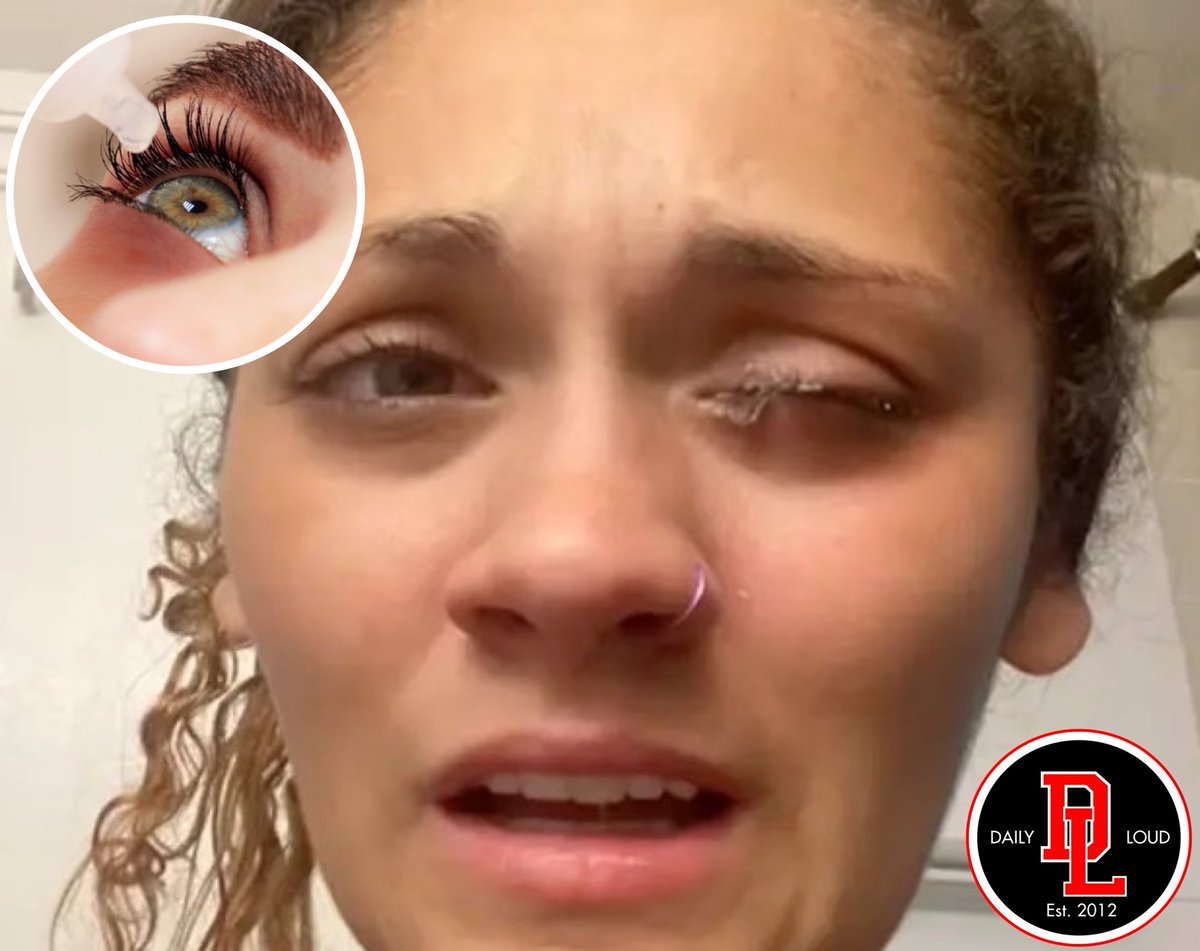 Woman mistook superglue for eye drops and fused her eyes shut 🤯👀