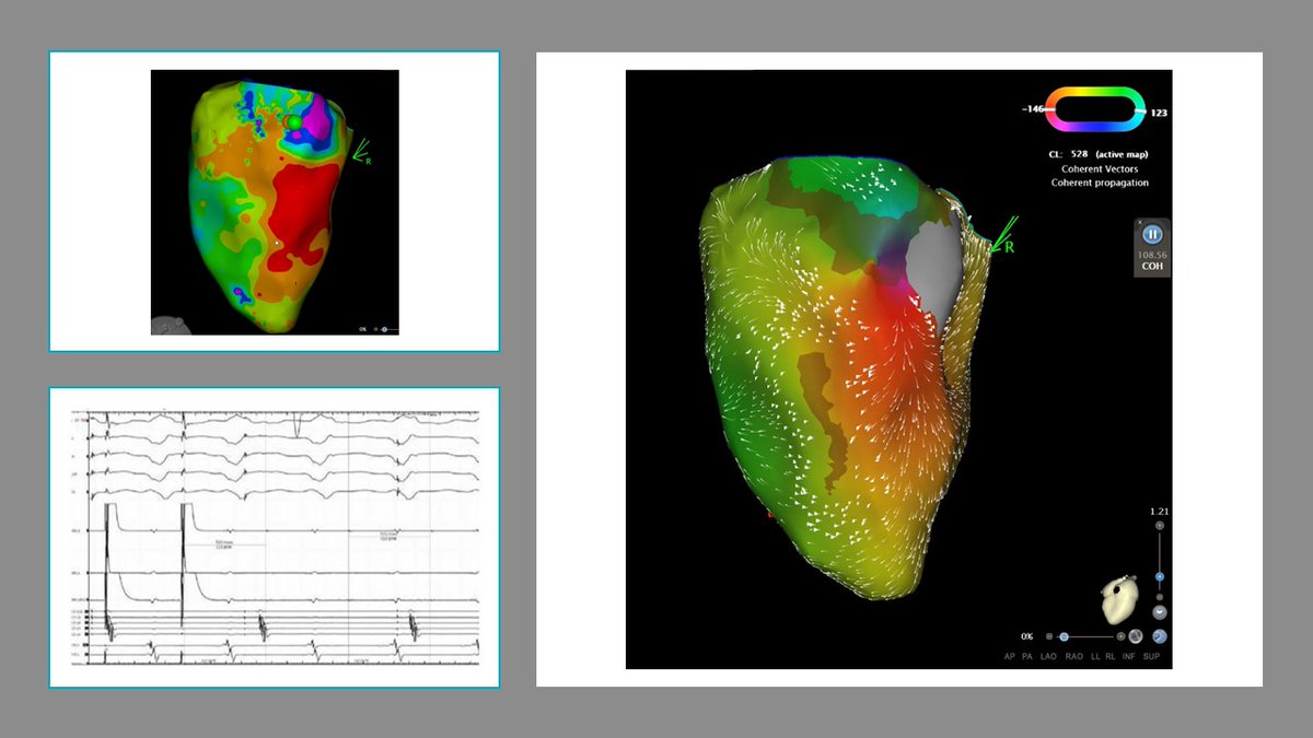 Single burn lovely day in Ep lab #VT #EPeeps 🥰 imaging advances which make circuits tangible