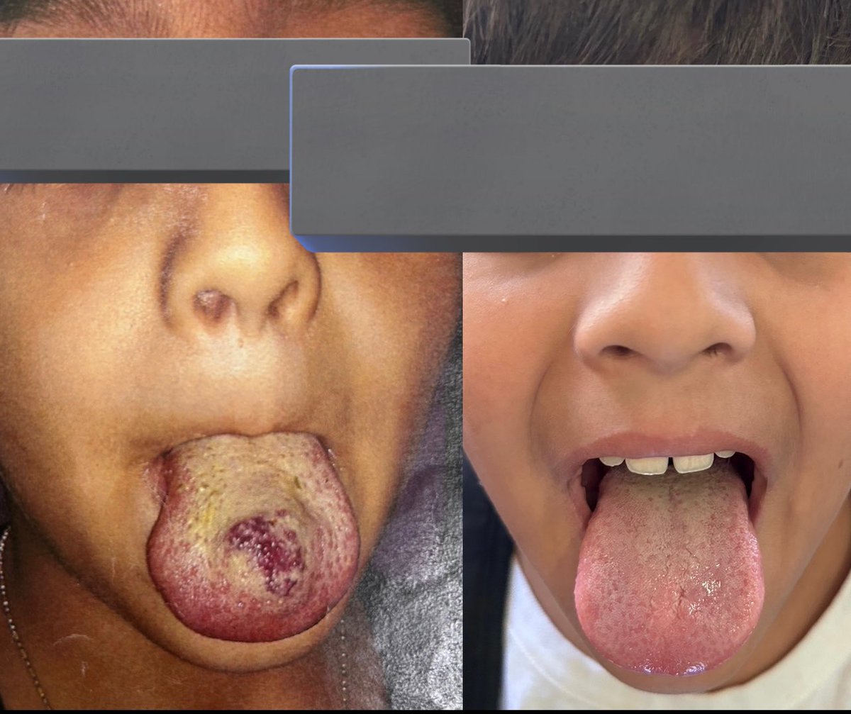 Dtepl's tweet photo. Large venous-lymphatic malformation of the tongue treated with a combination of #bleo and #STS, the photos are 6 months apart from the #sclerotherapy complete response without any residual clinical symptoms https://t.co/22OAJYgxYe