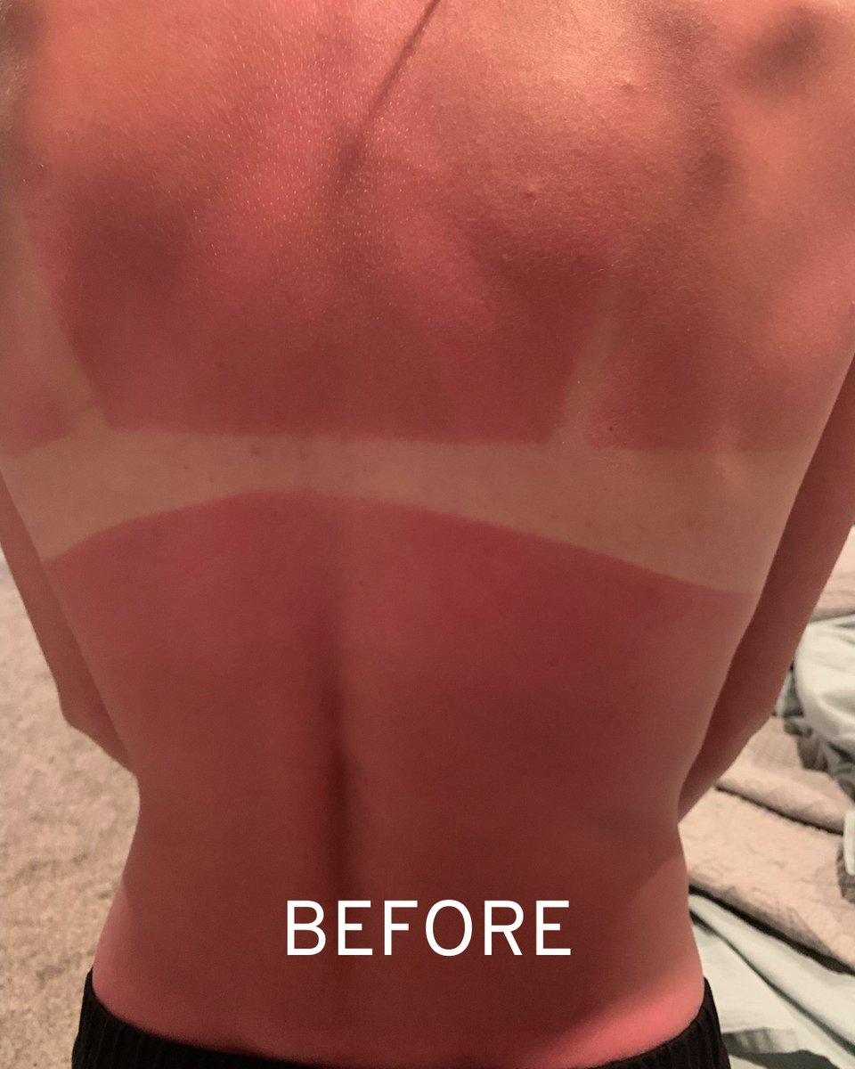 silverceuticals's tweet photo. BEFORE and AFTER:⁠ ☀️ ⁠
⁠
Check out the difference of this sun exposure in 3 days. ⁠
⁠
Our Nano-Silver Gel was made to encourage faster natural healing!⁠

⁠
#sunburn #naturalhealing #naturalhealth #nanosilver #silverceuticals https://t.co/lHeErX4f5e