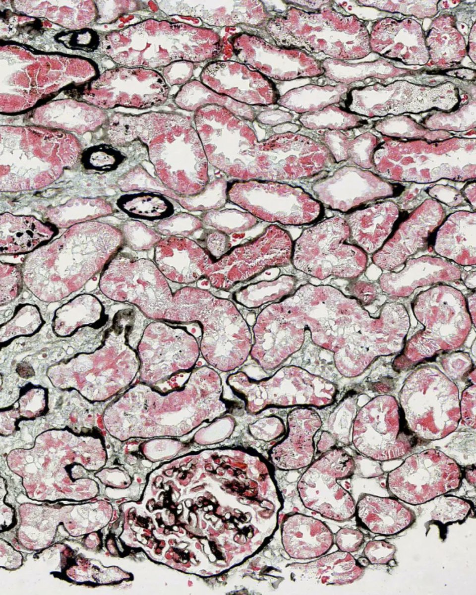 olkazuraw's tweet photo. When exploring the @BionovationI slide gallery for samples stained with special stain
I came across this kidney sample stained with the Periodic Schiff-Methenamine (PASM) staining (aka Jone's stain).
#KidneySample
#PeriodicSchiffMethenamine
#PASMStaining
#DigitalPathology https://t.co/JxJqyxry68
