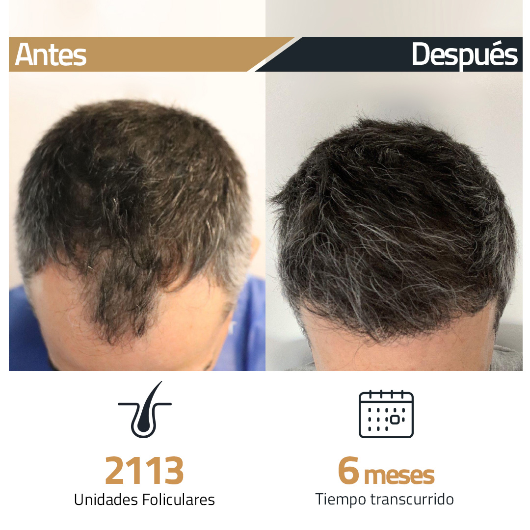 insparya_es's tweet image. En #Insparya, nunca es tarde para recuperar tu autoestima y seguridad.
¡Con el trasplante capilar recupera lo que has perdido! Más de 50.000 pacientes de éxito con el Método Insparya.
Llama al📲900 696 020 o visitando nuestra página web en insparya.es